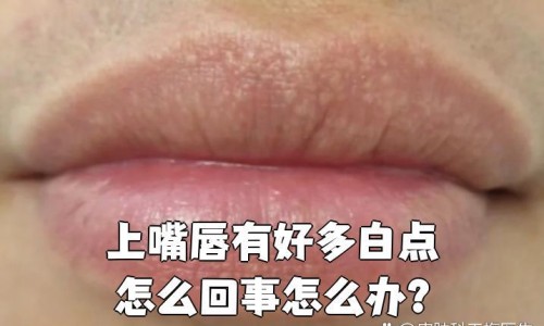 怀孕期间痔疮犯了可以用痔疮膏吗-孕妇痔疮可以用药吗、孕妇痔疮能抹蜂蜜吗有影响吗 -孕妇痔疮能抹蜂蜜吗网